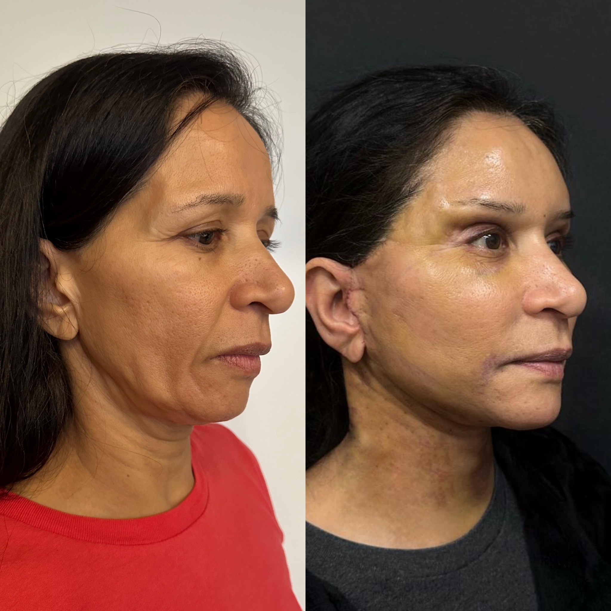 face neck lift deep plane and browlift 4 days post-op before after oblique view