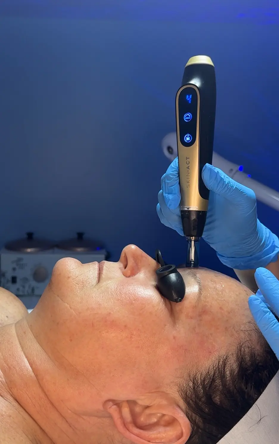 Marissa performing microneedling
