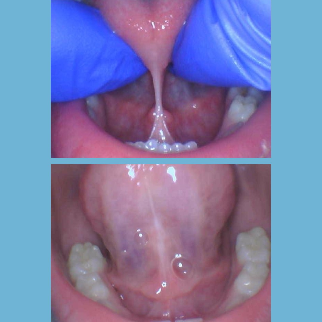 Before and after comparison of a laser tongue-tie frenectomy procedure for improved tongue mobility.