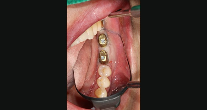 36,37 커스텀 장착