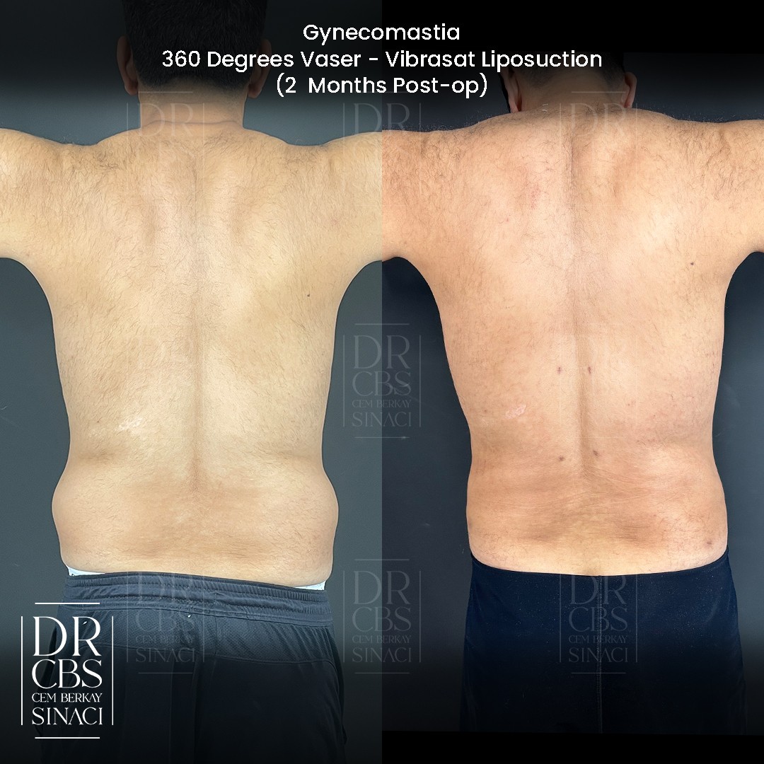 gynecomastia correction vaser liposuction and laser skin tightening for abdomen before after back view