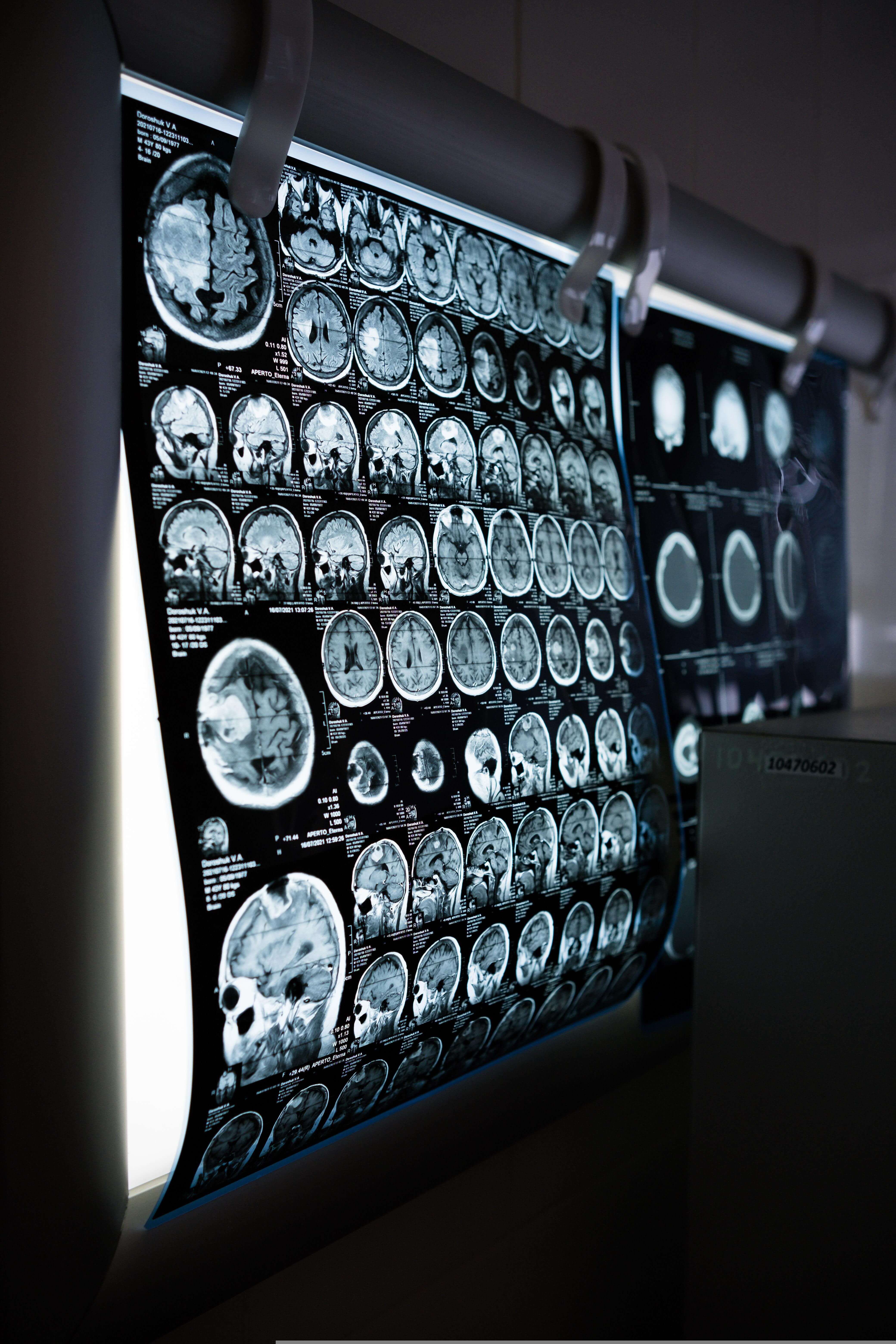 AI for MRI scans