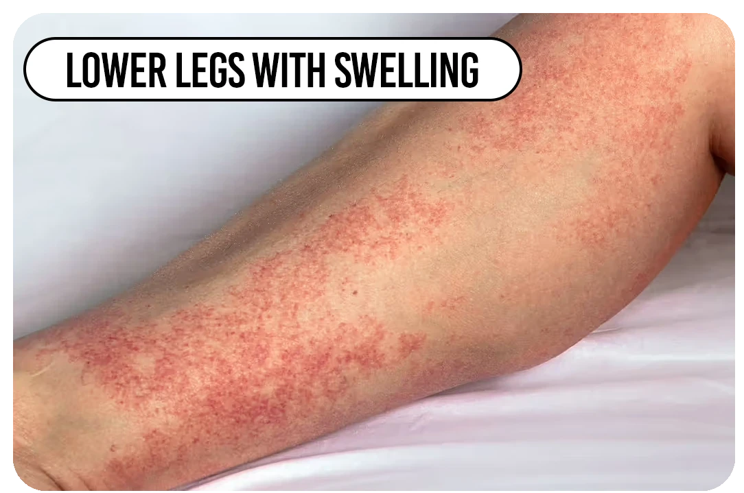 Lower legs with swelling