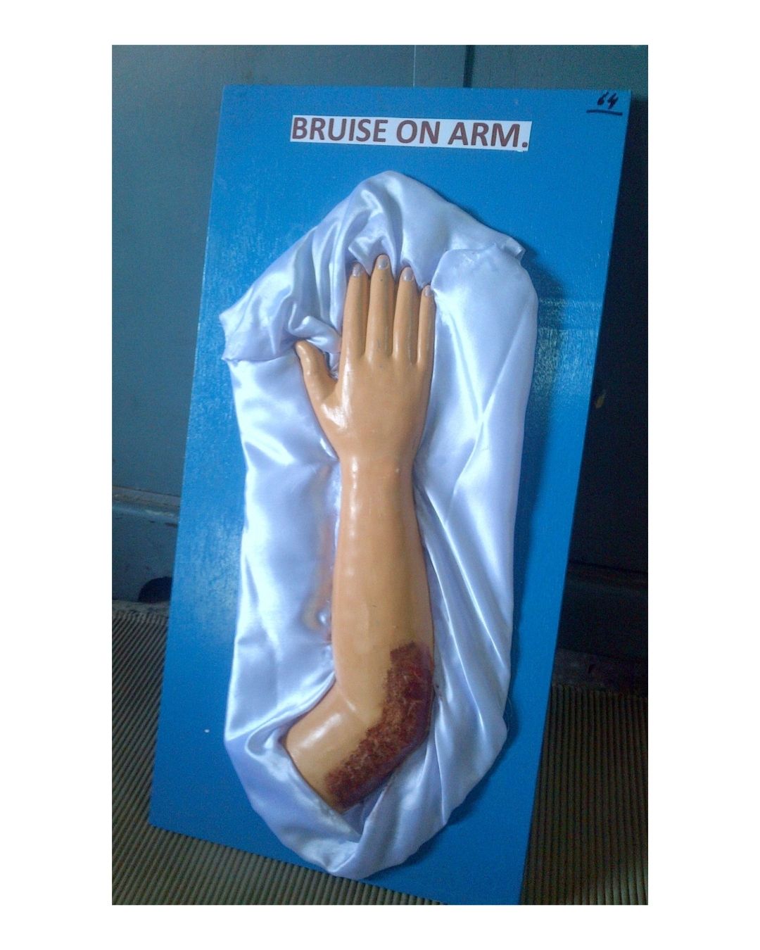 Bruise on Arm