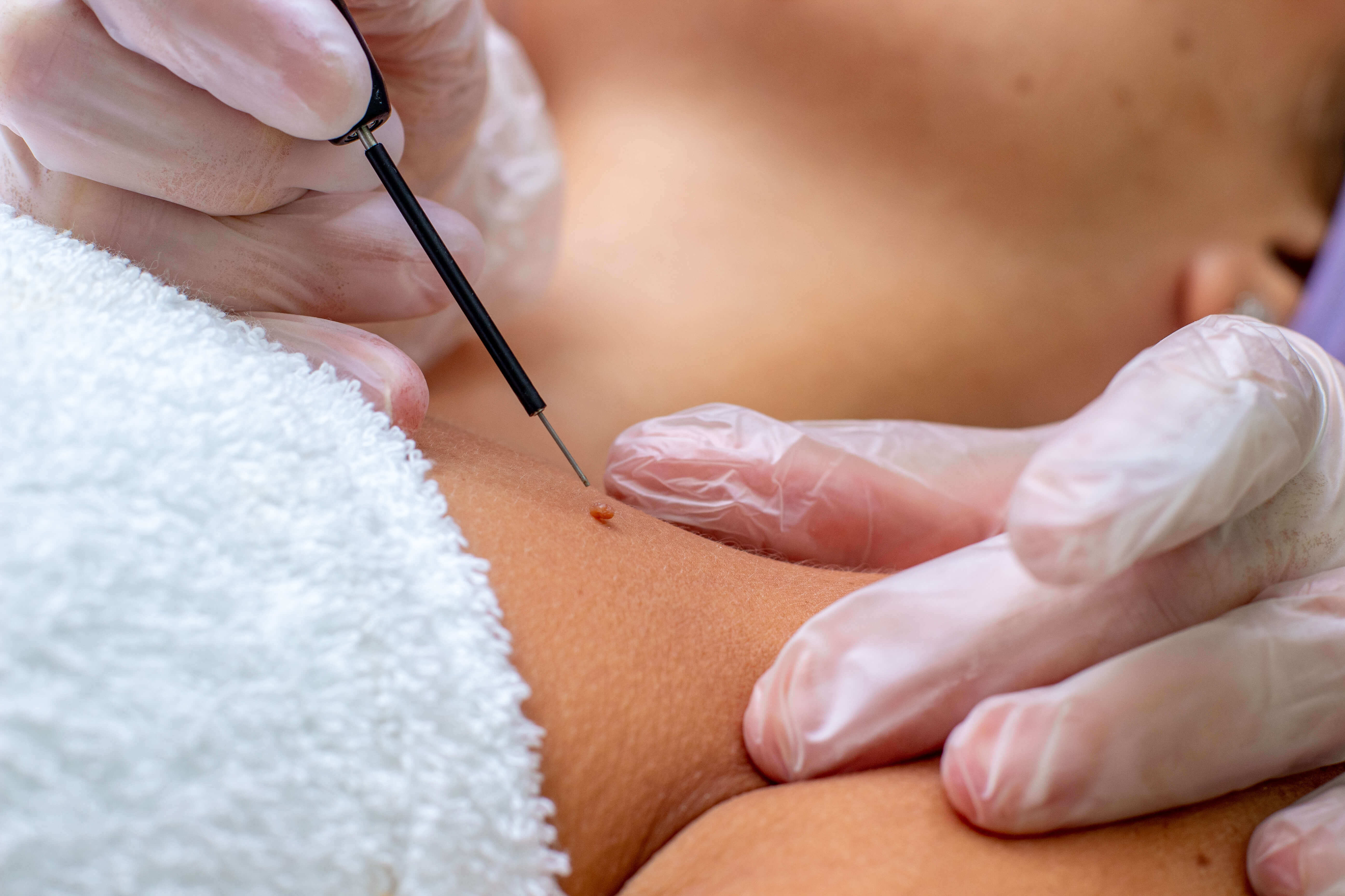 Precyzyjna elektrokoagulacja skóry dla usunięcia niedoskonałości.