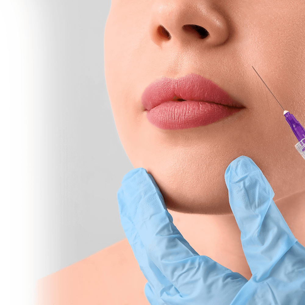 planning of nasolabial fold filler injection