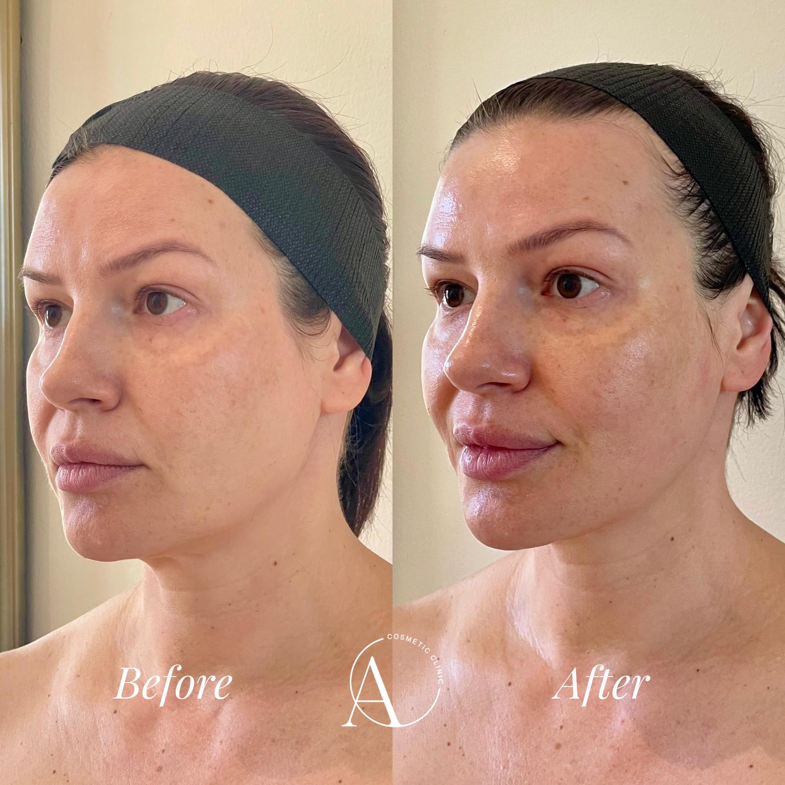 HIFU Treatment sydney amirova cosmetic clinic
