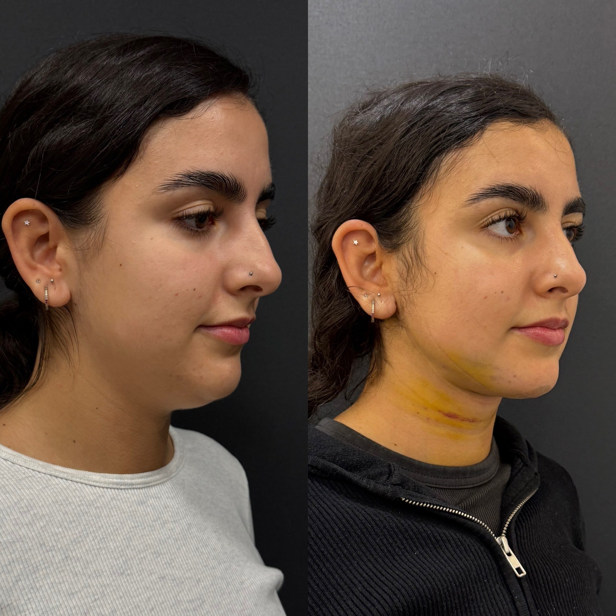 double chin laser liposuction before after 4 days post-op oblique view