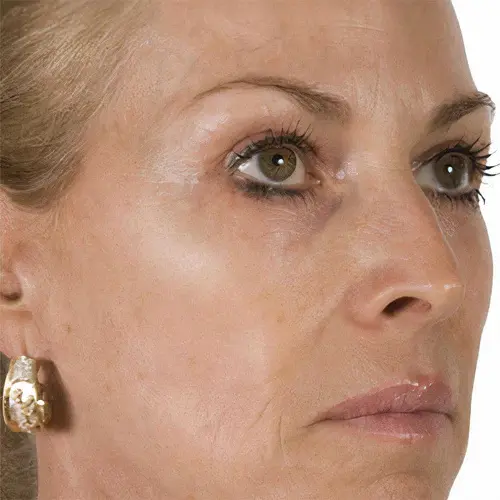 After growth factors anti-aging treatment at The Vancouver Aesthetician — skin visibly tighter, lifted and younger looking with a brighter healthier complexion restored
