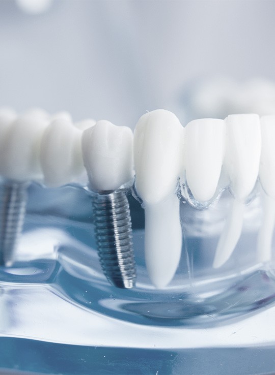 Best Dental Implants  Hong Kong