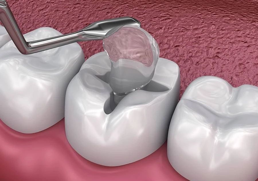 dental fillings