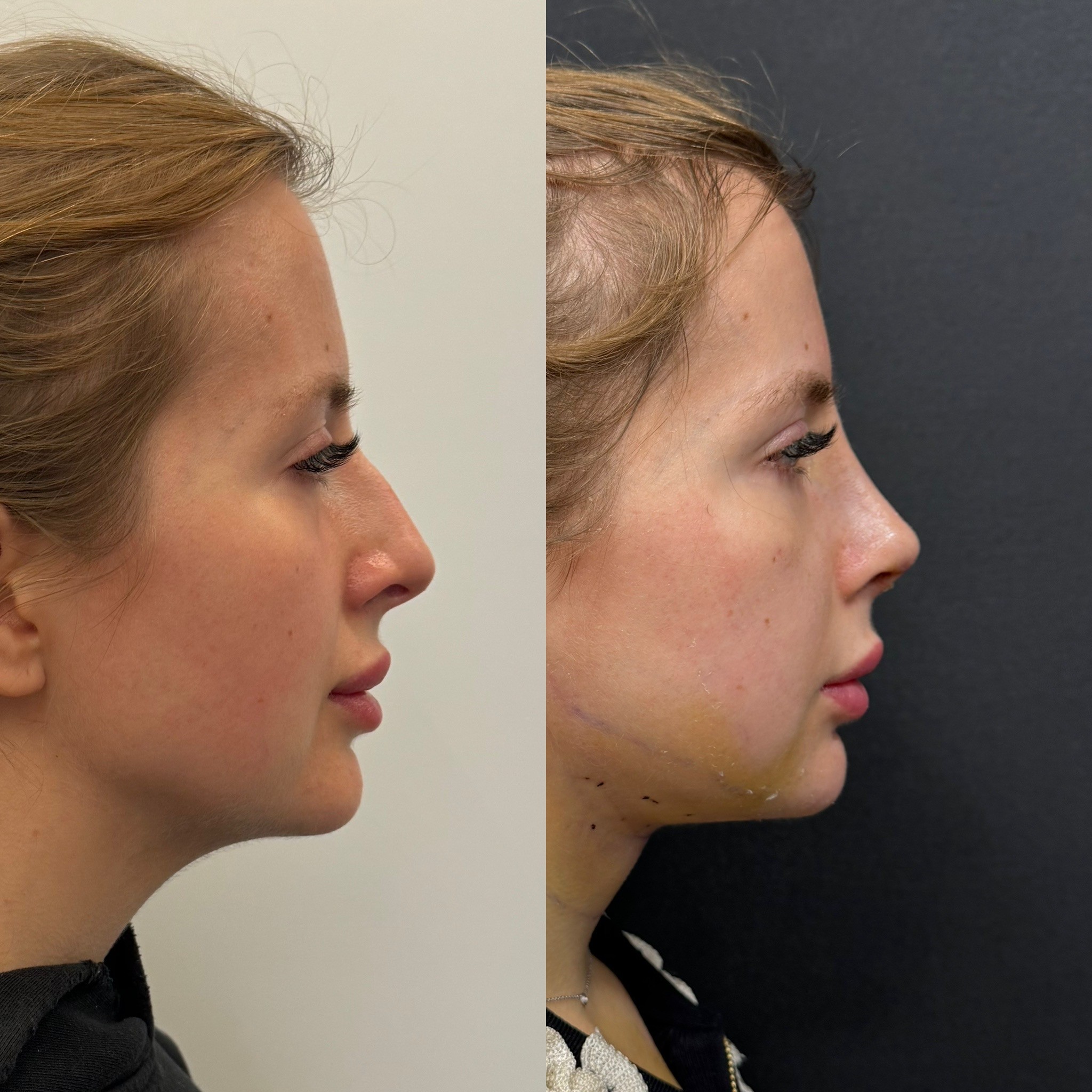 before after necklift and rhinoplasty 5 days post surgery side view