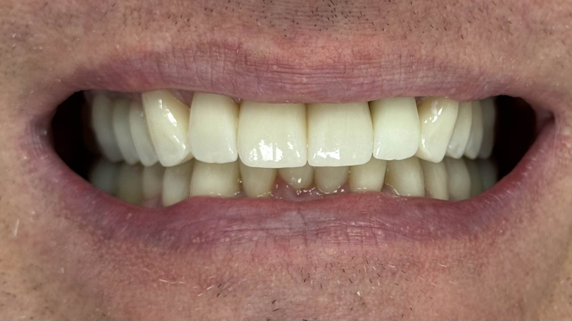 Crowns, Full smile redesign - after treatment