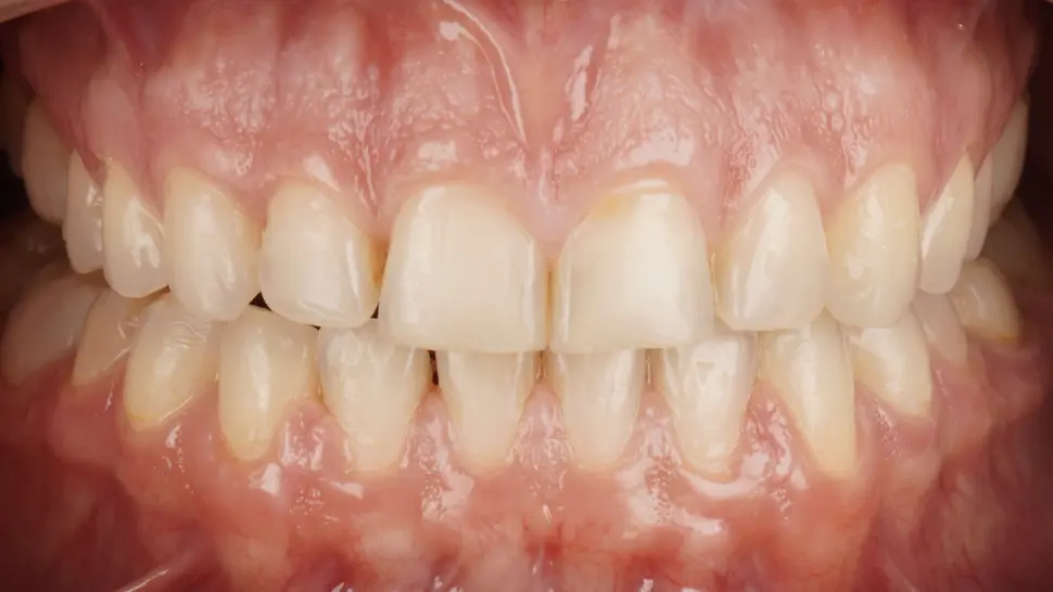 After ortho treatment