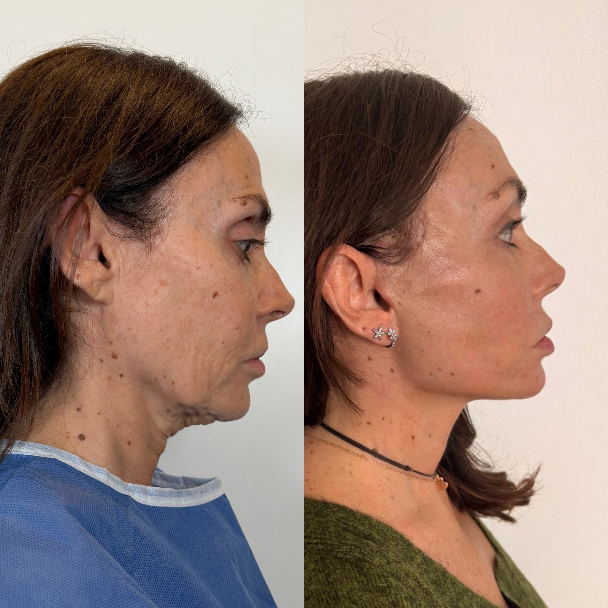 deep plane face and neck lift nano fat inhection co2 laser before after side view