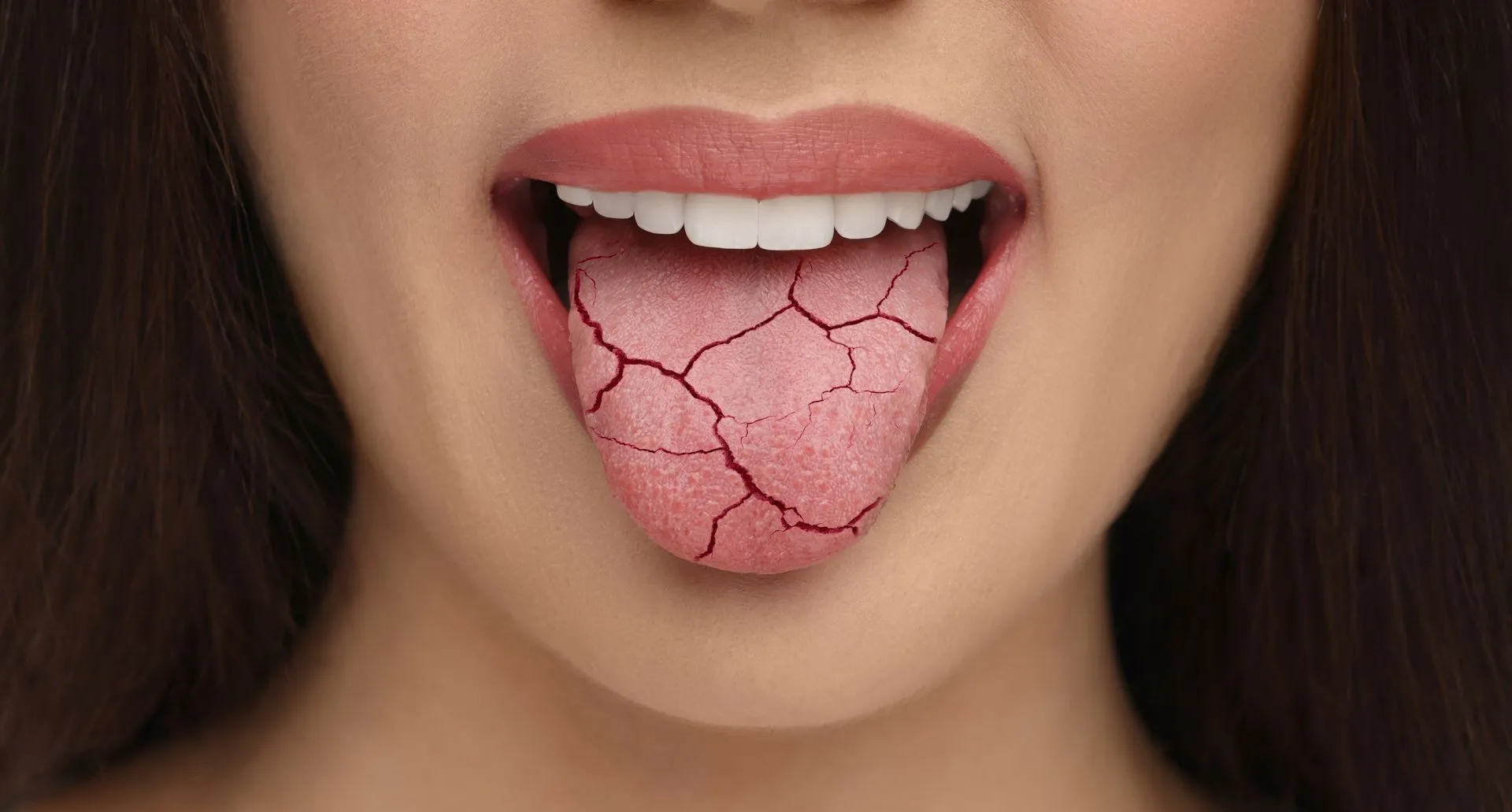 Xerostomia ou boca seca