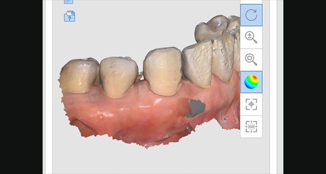 교정후 잉여공간 초진 스캔