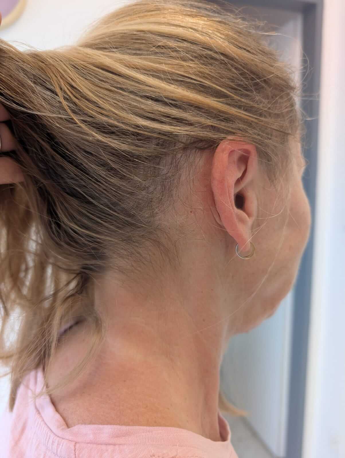 Fotografia výsledku vlasovej mezoterapie na konci 6 ošetrenia.