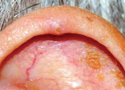 Figure 6: Chondrodermatitis nodularis helices chronicus