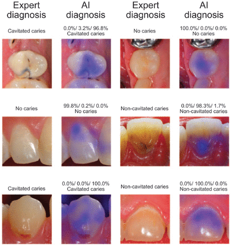 AI vs human dentists caries diagnosis study results