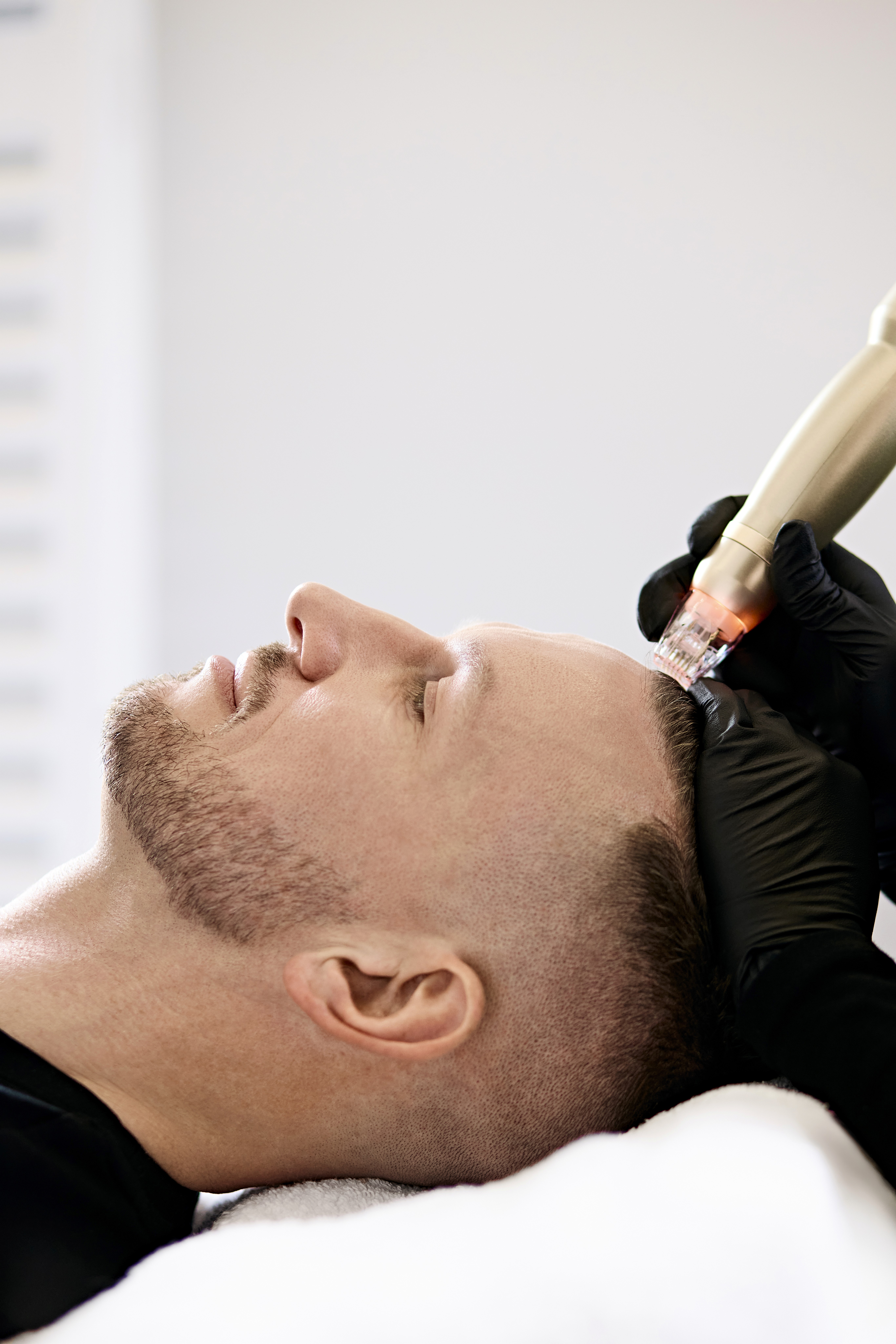 Man receiving RF microneedling treatment with radiofrequency device on skin