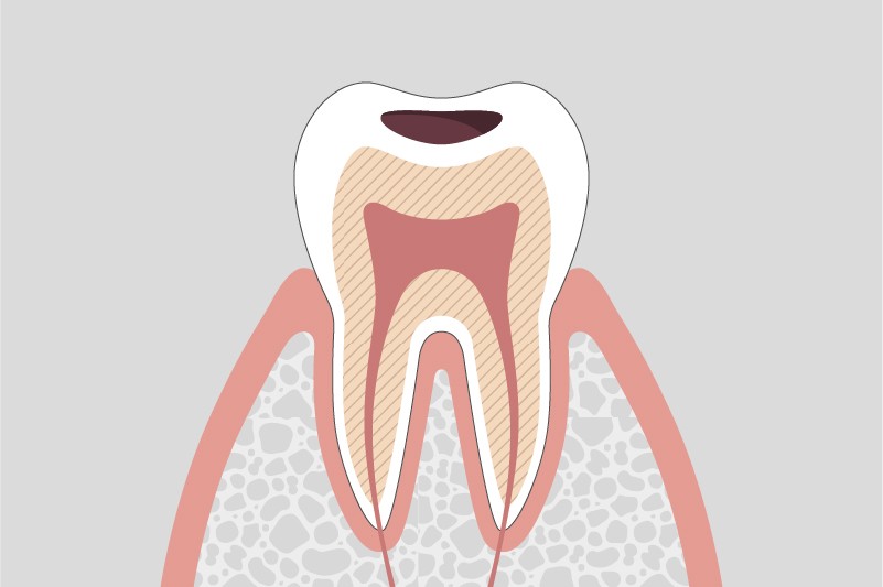 むし歯の進行段階とその治療方法
