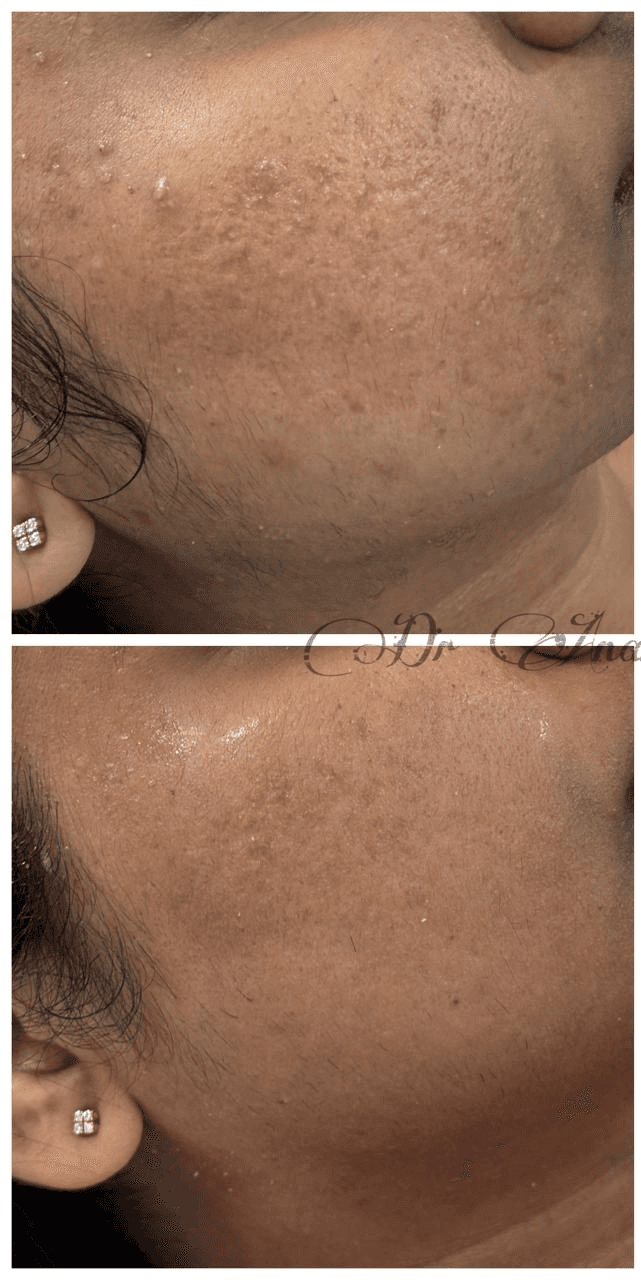 Woman applying face cream, skincare routine