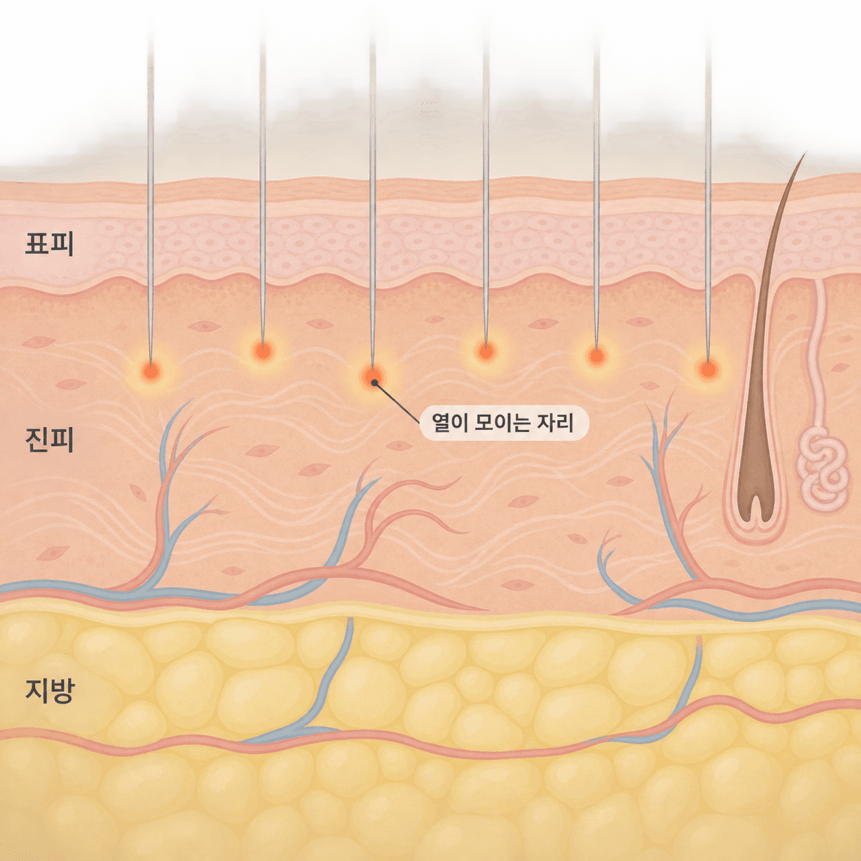 바늘 끝에서 열이 모이고, 겉에는 점 같은 바늘 자리와 붉은기가 남아요
