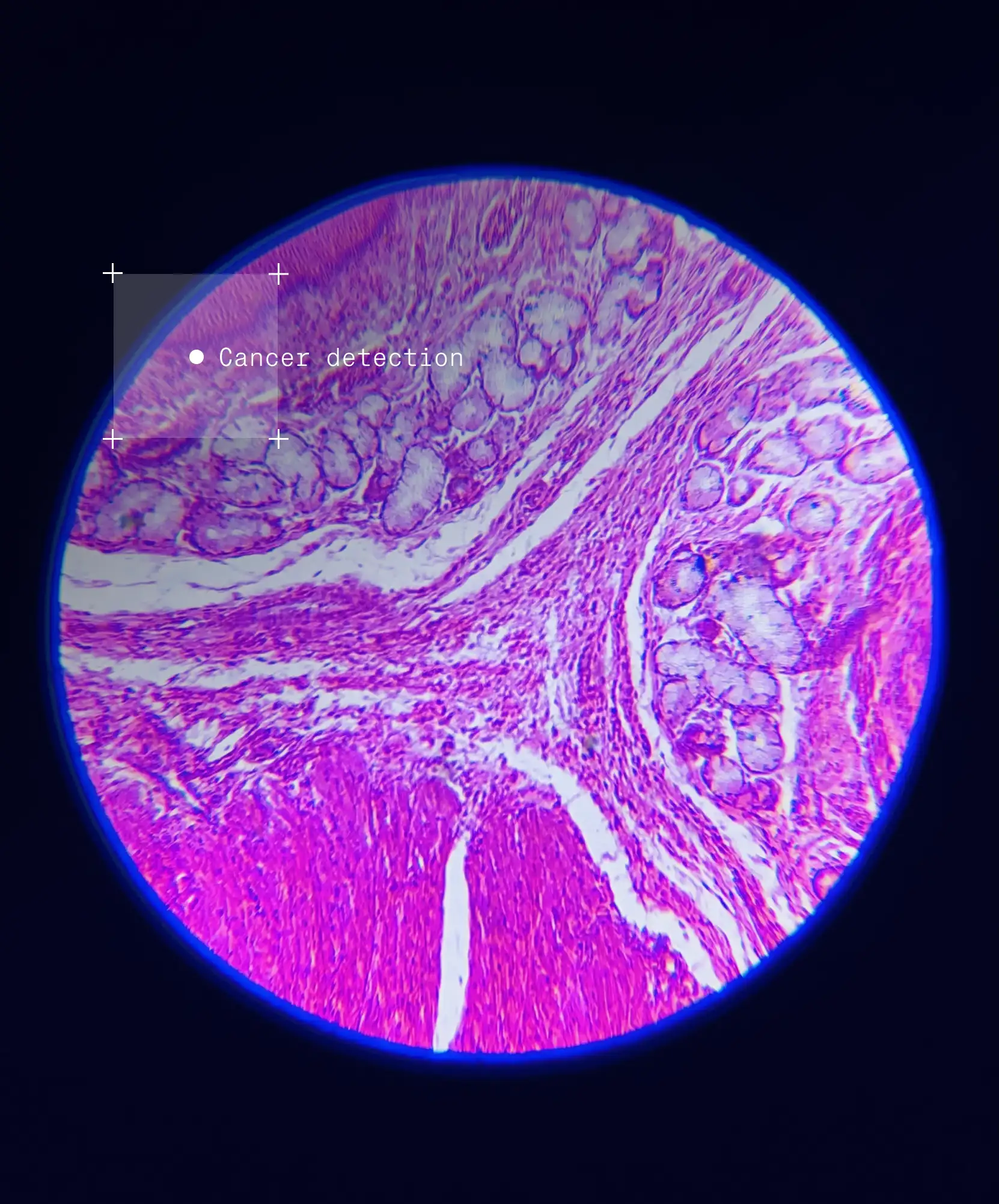 Image of cancer tetected in WSI