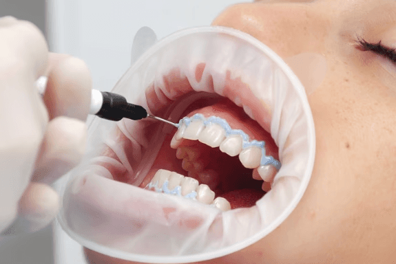 tooth whitening