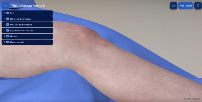 Tibial plateau fracture - lateral locking plate