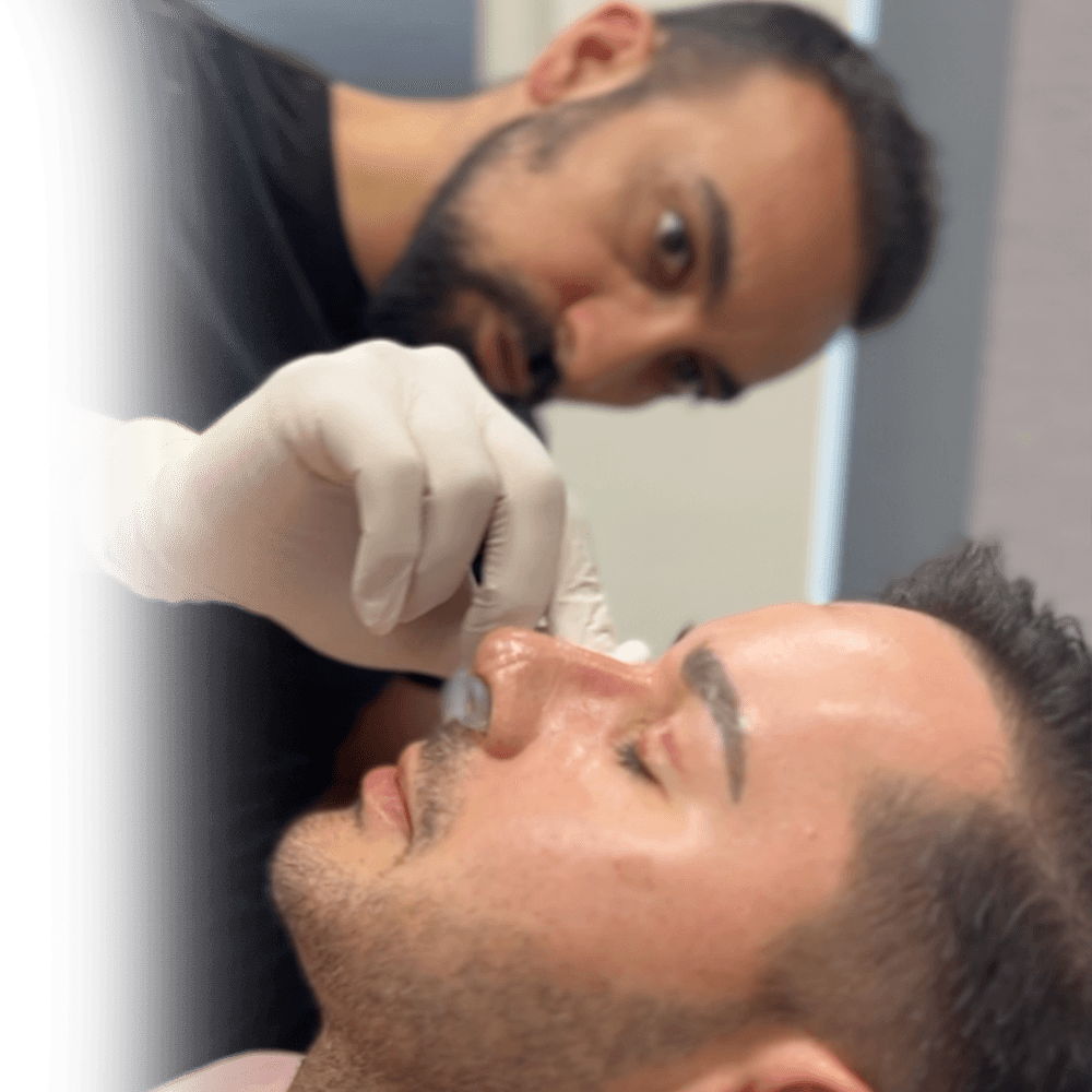 a revision rhinoplasty patient of Dr.CBS after cast removal