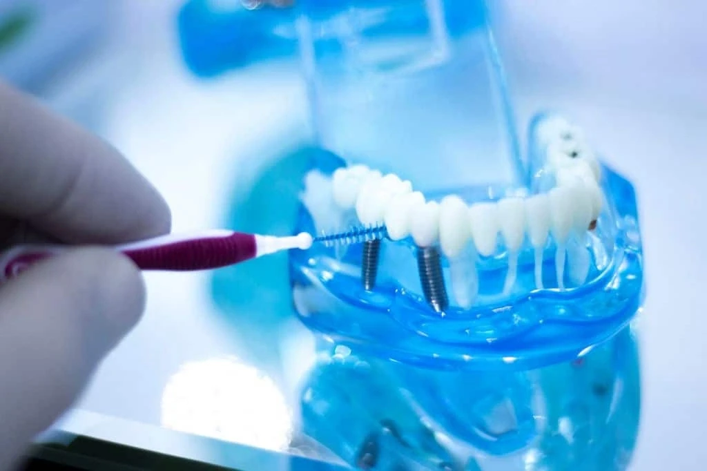 dental implant maintenance