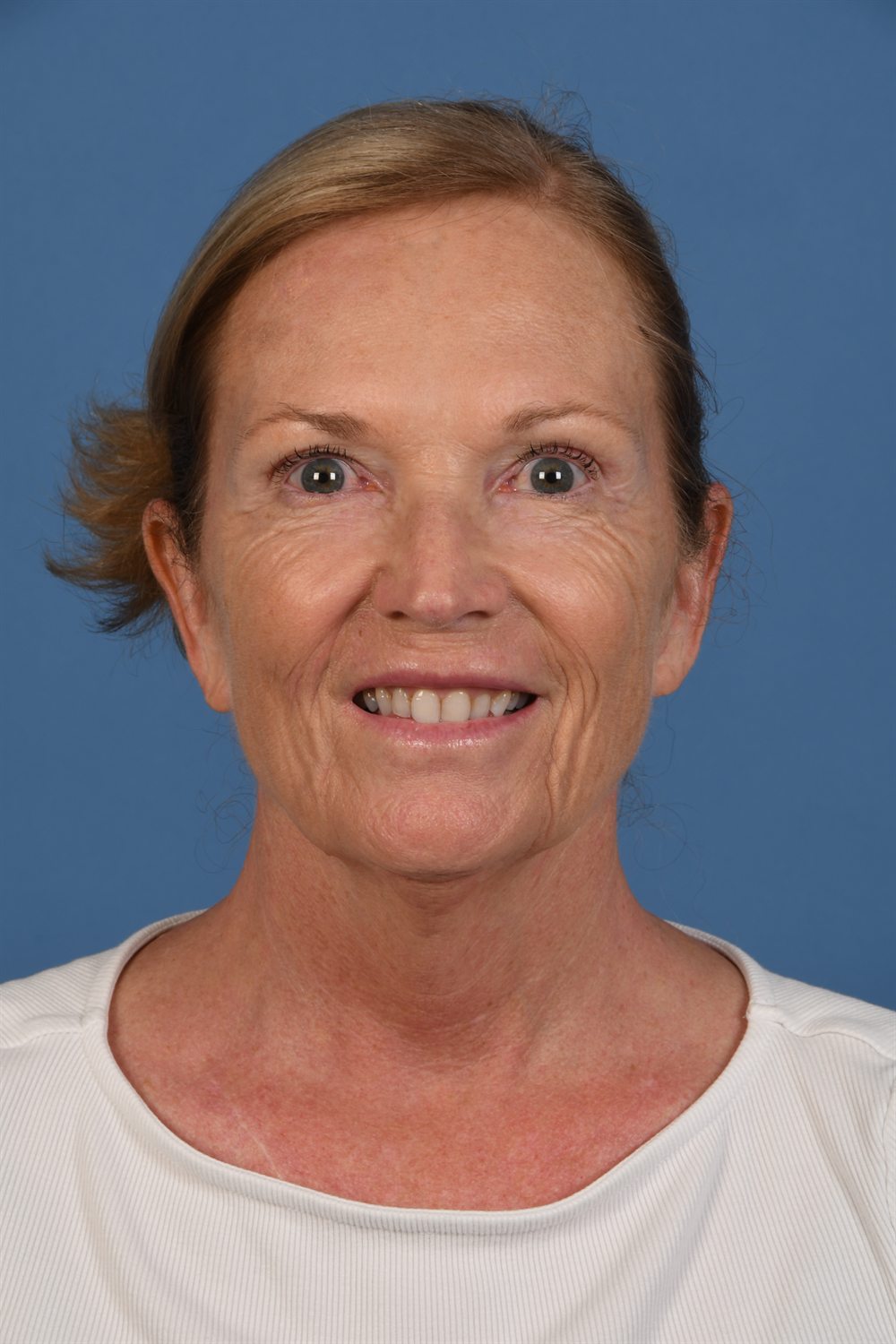 Facelift patient before surgery, front, smiling