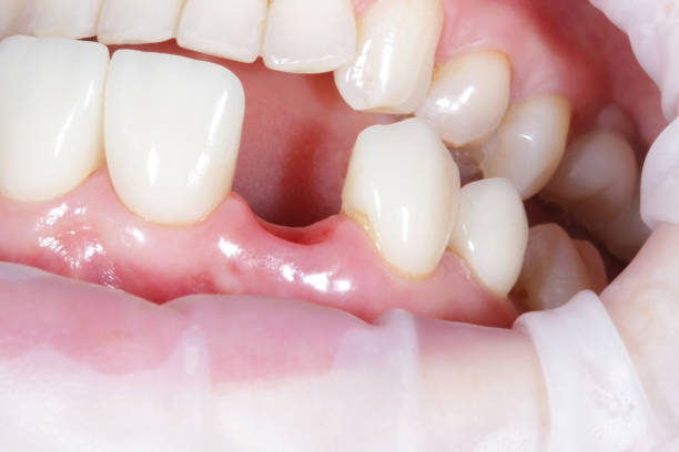 front tooth crown