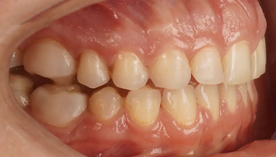 After ortho treatment