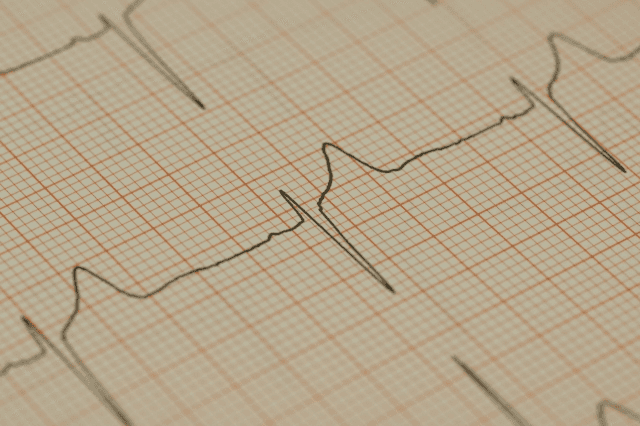 心電図検査で分かること