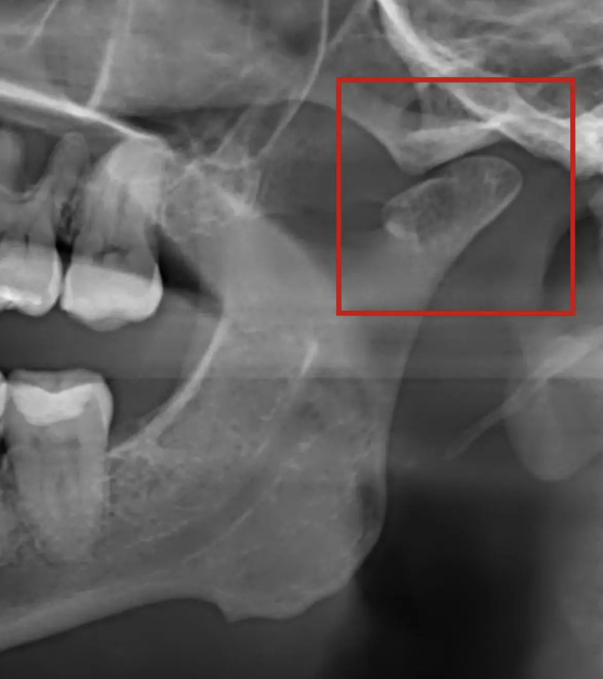 Arthritic TMJ
