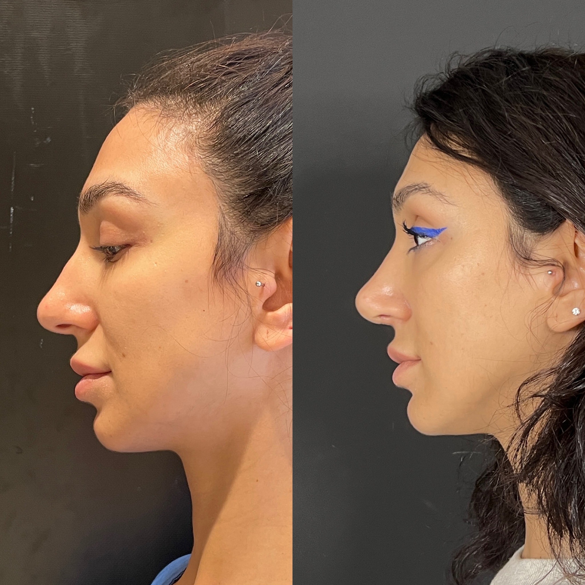 3 weeks post-surgery before after of rhinoplasty side view