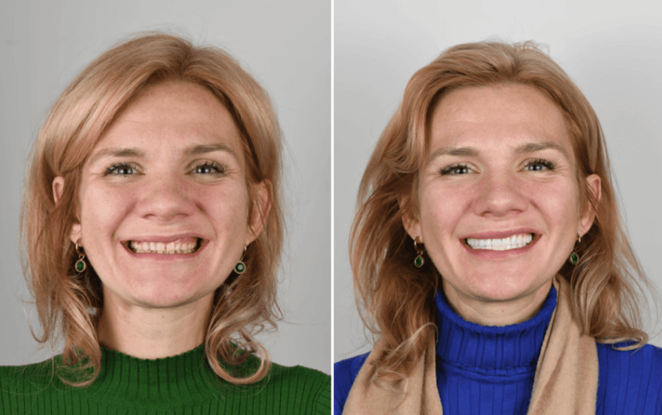 veneers treatment (before/after) at Invisalign center Dubai