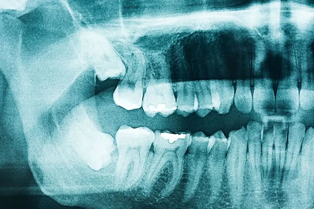 Wisdom Teeth Removal in Hong Kong: All You Need to Know