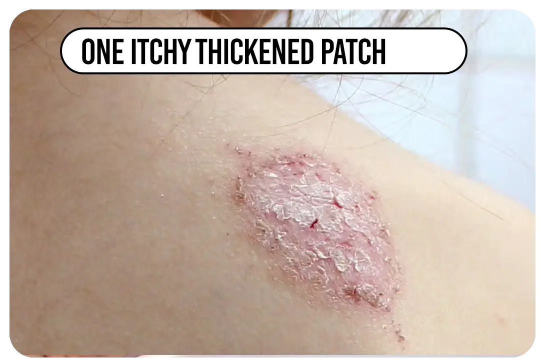 One itchy thickened patch