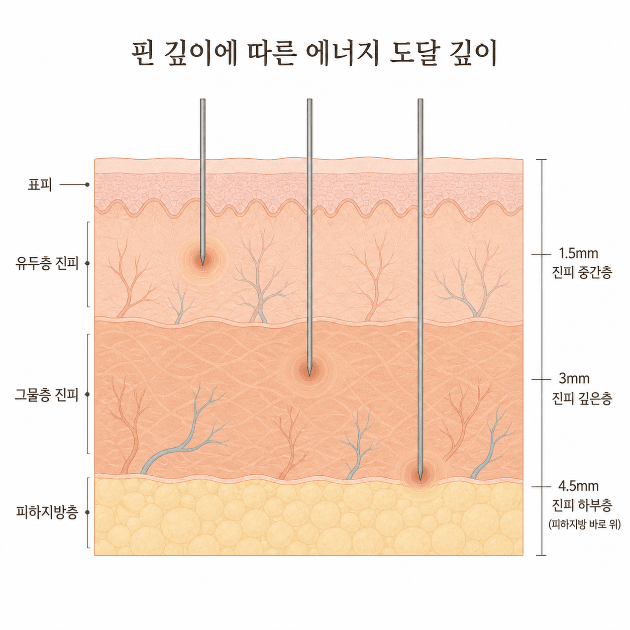니들 깊이에 따라 열이 생기는 지점이 달라지는 모습