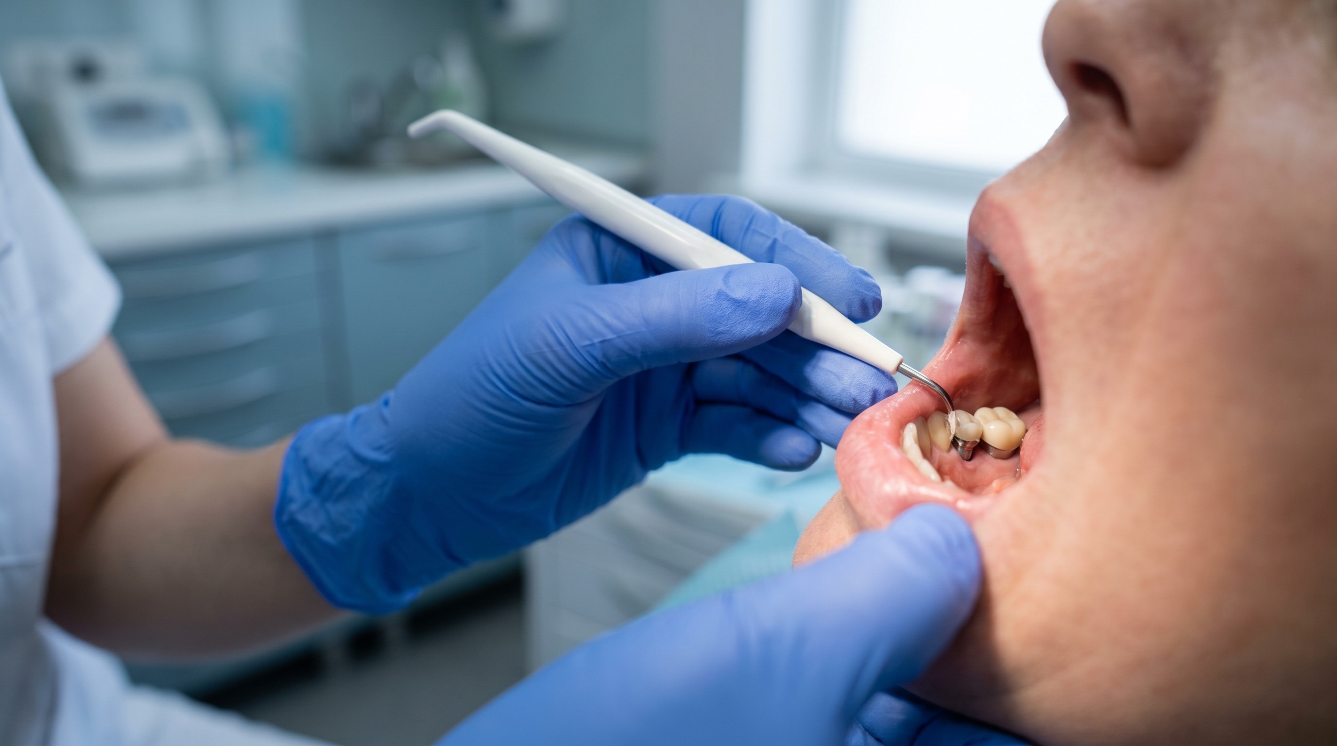 Gloved hands using a plastic scaler to clean gum tissue around a dental implant
