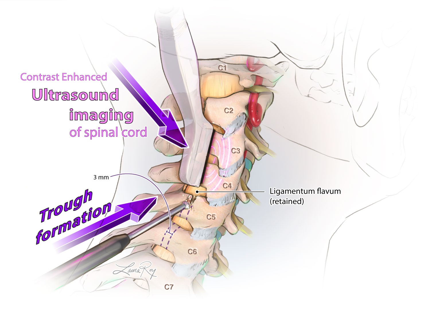 Trough Technique for Ultrasound Imaging