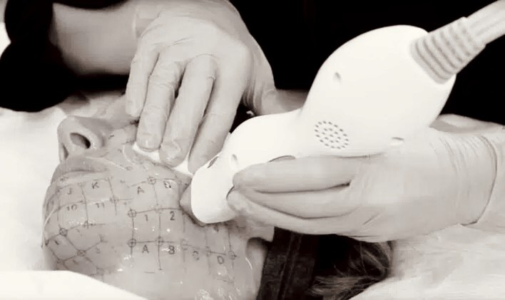 Hautstraffung  Gesicht und Kollagenboost mit Thermage FLX Bad Wörishofen Allgäu