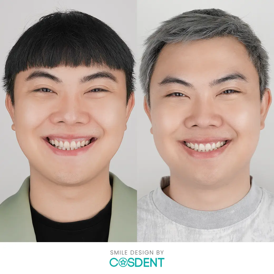 เคสทำวีเนียร์ หมอฝน cosdent smile design