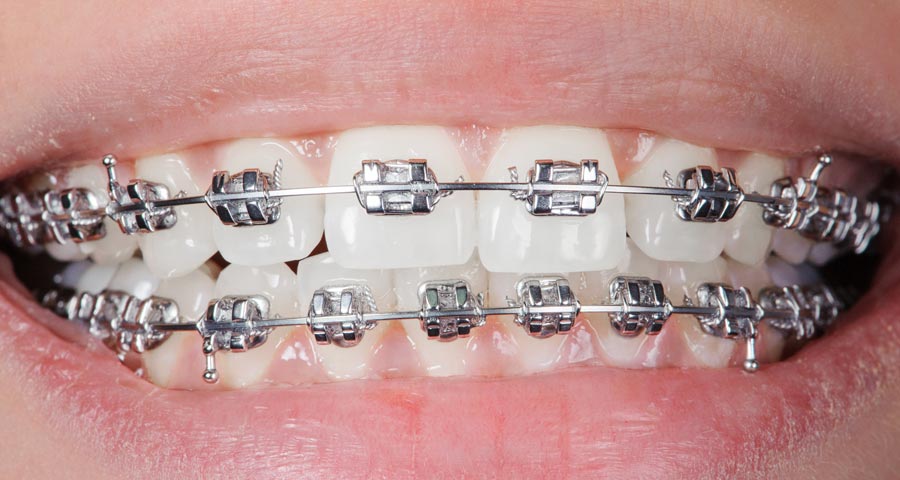 traditional braces