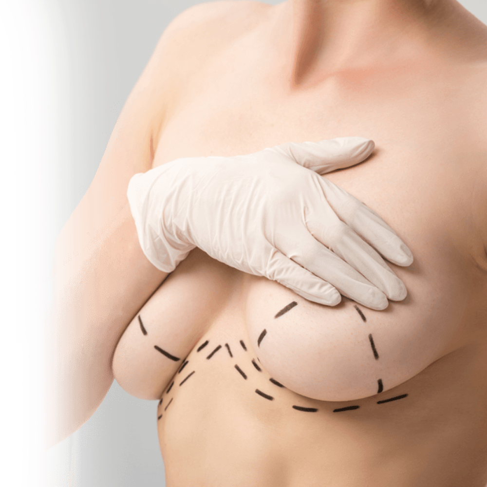 scar placement of breast lift surgery