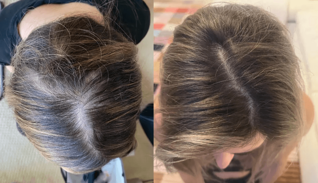 minoxidil works to treat female hair thinning